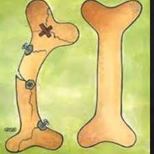 آمار مرگ های ناشی از پوکی استخوان وحشتناک است