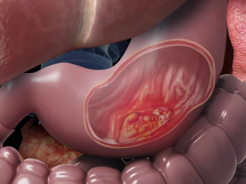 سرطان معده کشنده ترین سرطان در ایران